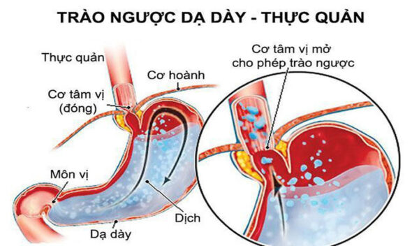Phương thức hay chữa trào ngược dạ dày – thực quản