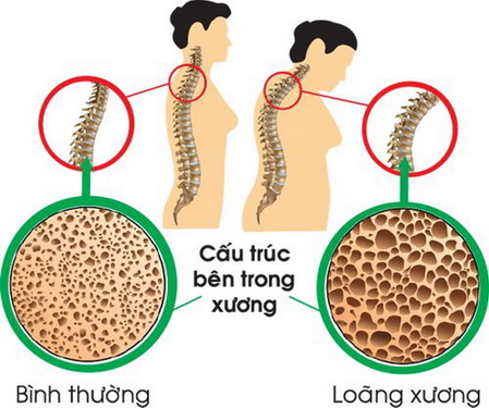 Làm gì để tránh loãng xương?