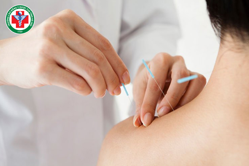 Châm cứu góp phần loại trừ Hàn khí