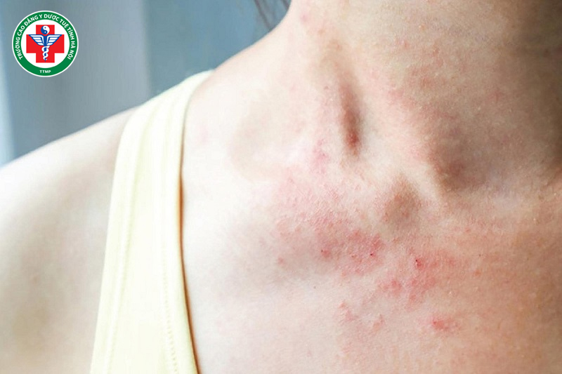 Cơ thể bị thấp khí khiến da dễ nổi mẩn
